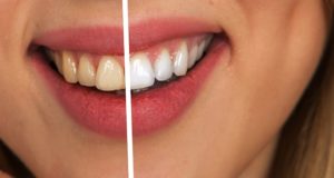 Increíbles tips para blanquear tus dientes en casa