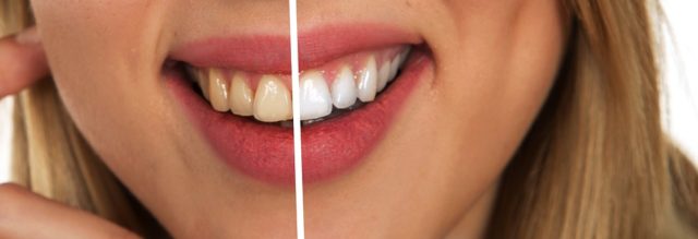 Increíbles tips para blanquear tus dientes en casa